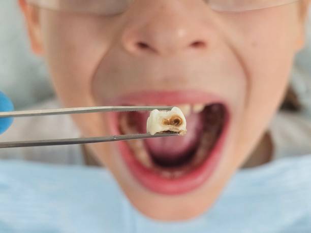 Best Emergency Tooth Extraction in Trussville, AL