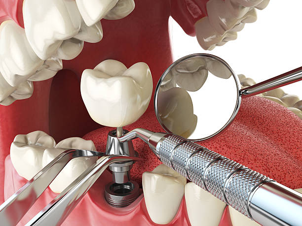Best Urgent Care for Lost Fillings or Crowns in Trussville, AL